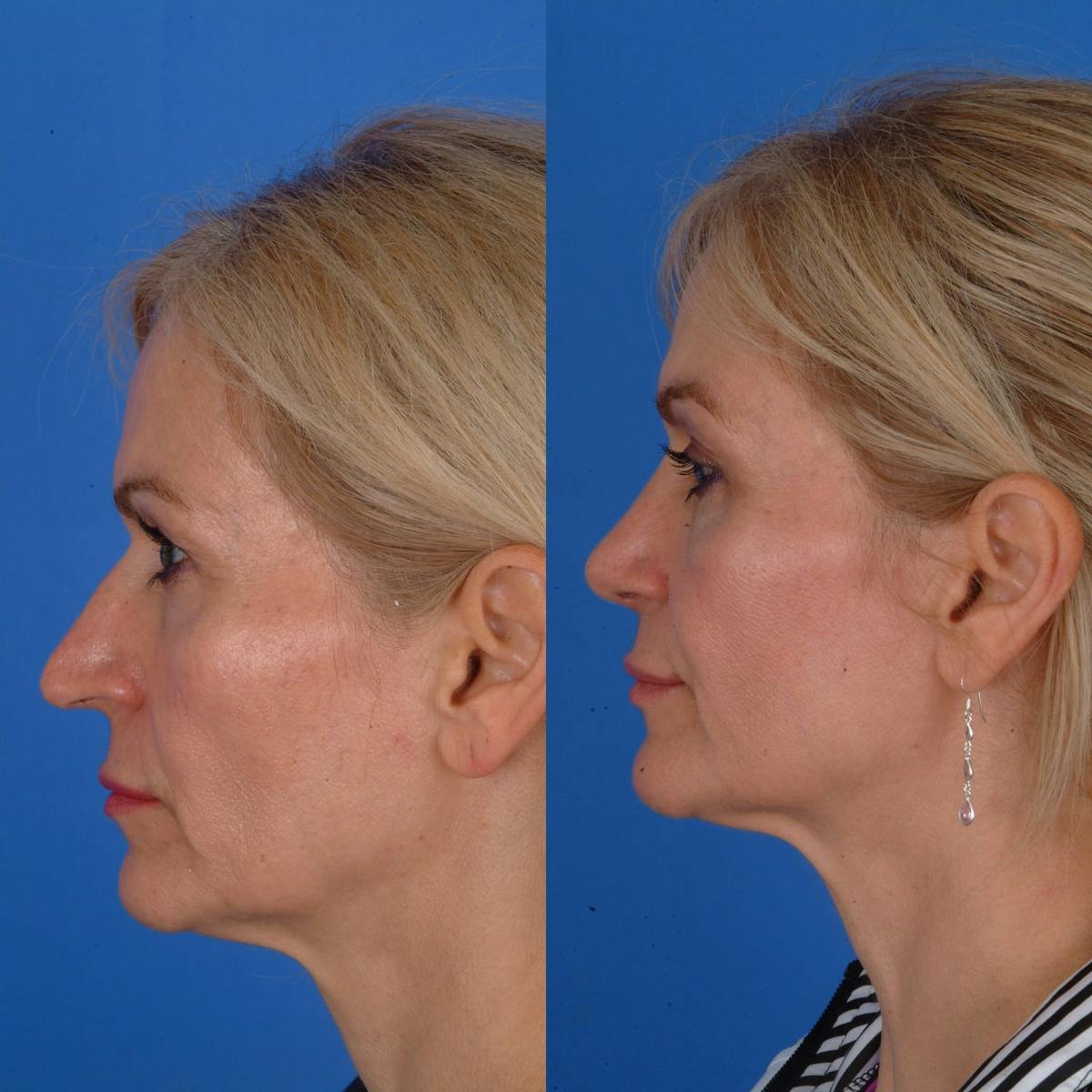 Rhinoplasty Before & After Gallery - Patient 179507137 - Image 1