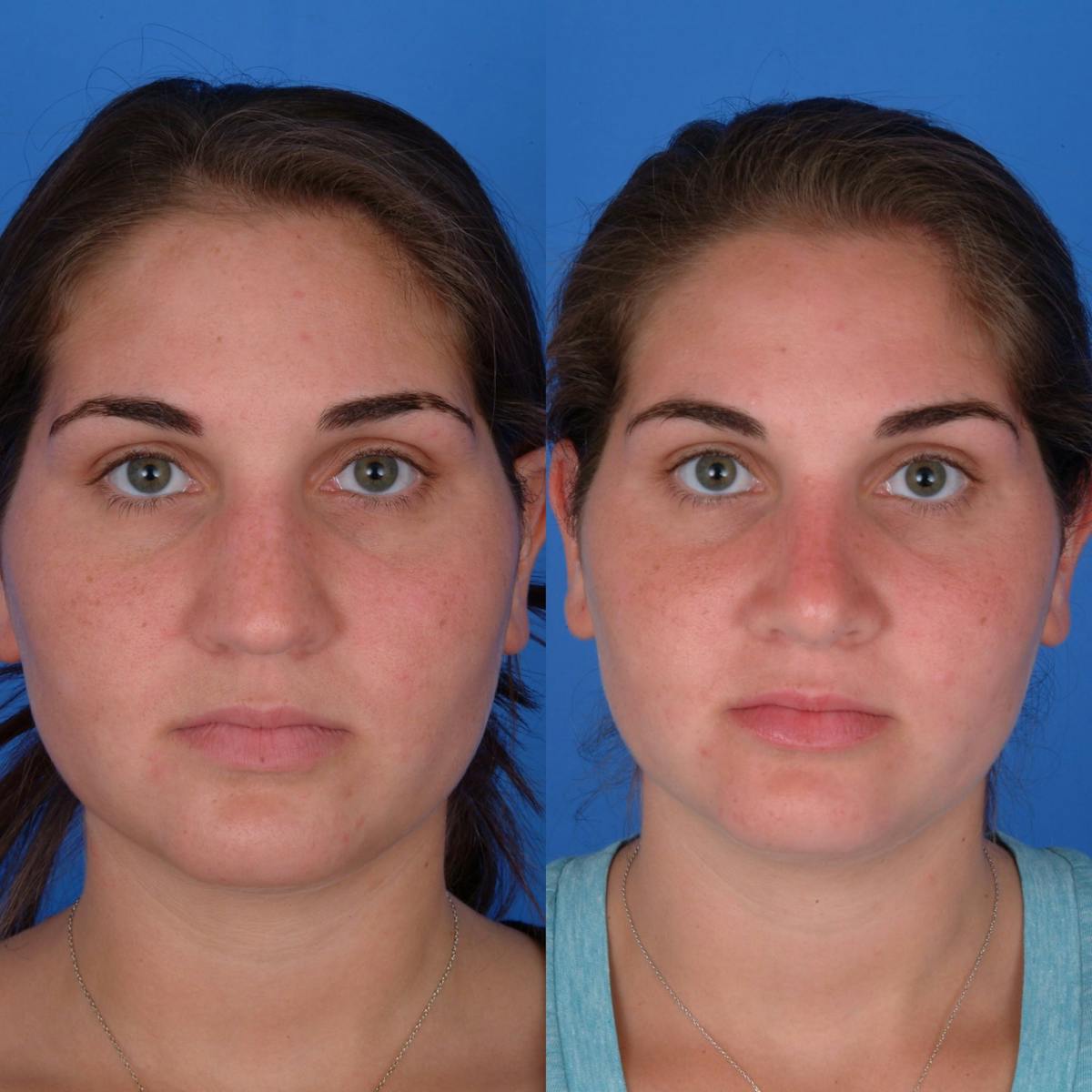 Rhinoplasty Before & After Gallery - Patient 179507136 - Image 2