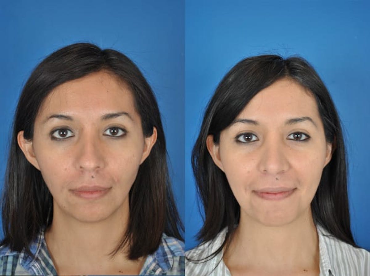 Rhinoplasty Before & After Gallery - Patient 179507476 - Image 2