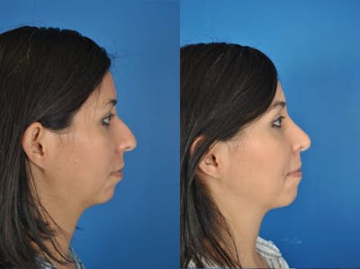 Rhinoplasty Before & After Gallery - Patient 179507476 - Image 1