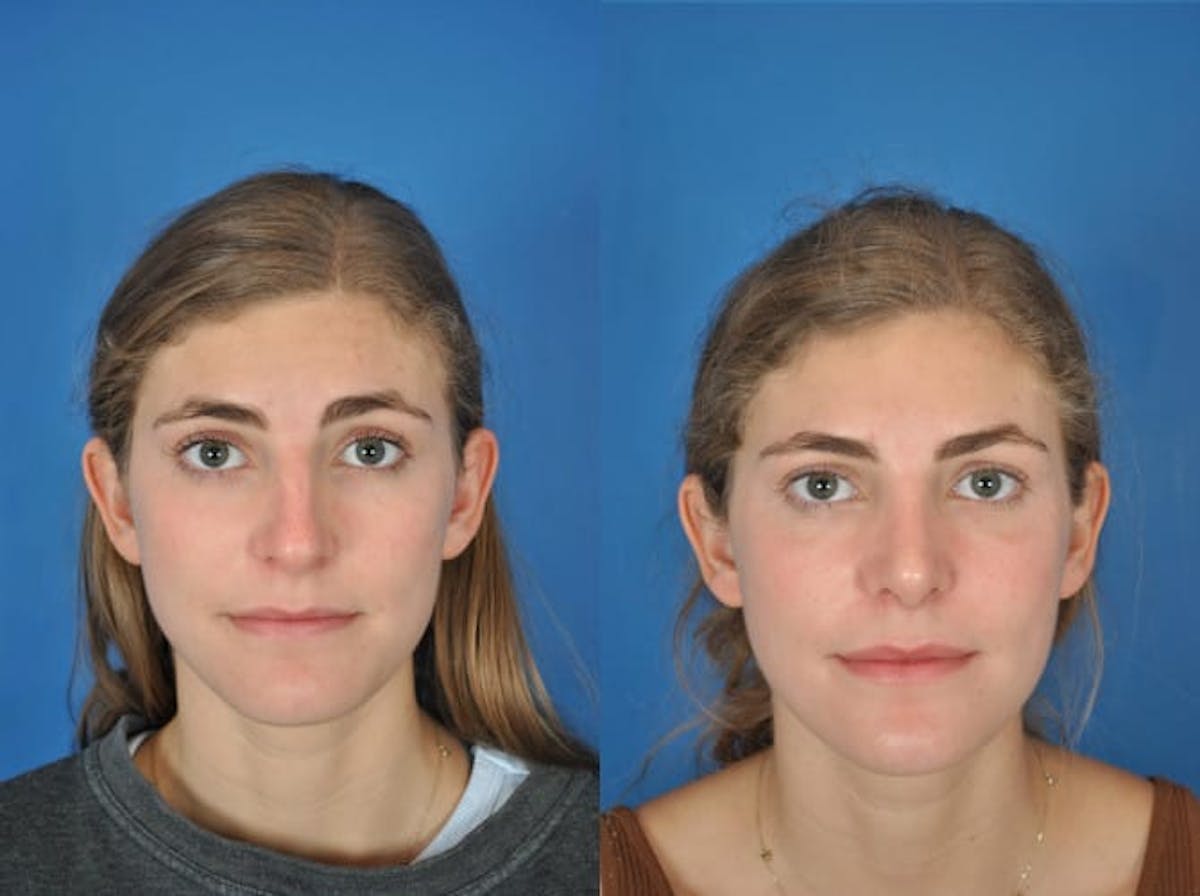 Rhinoplasty Before & After Gallery - Patient 179507630 - Image 2