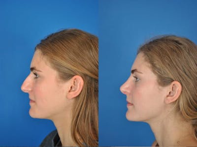 Rhinoplasty Before & After Gallery - Patient 179507630 - Image 1
