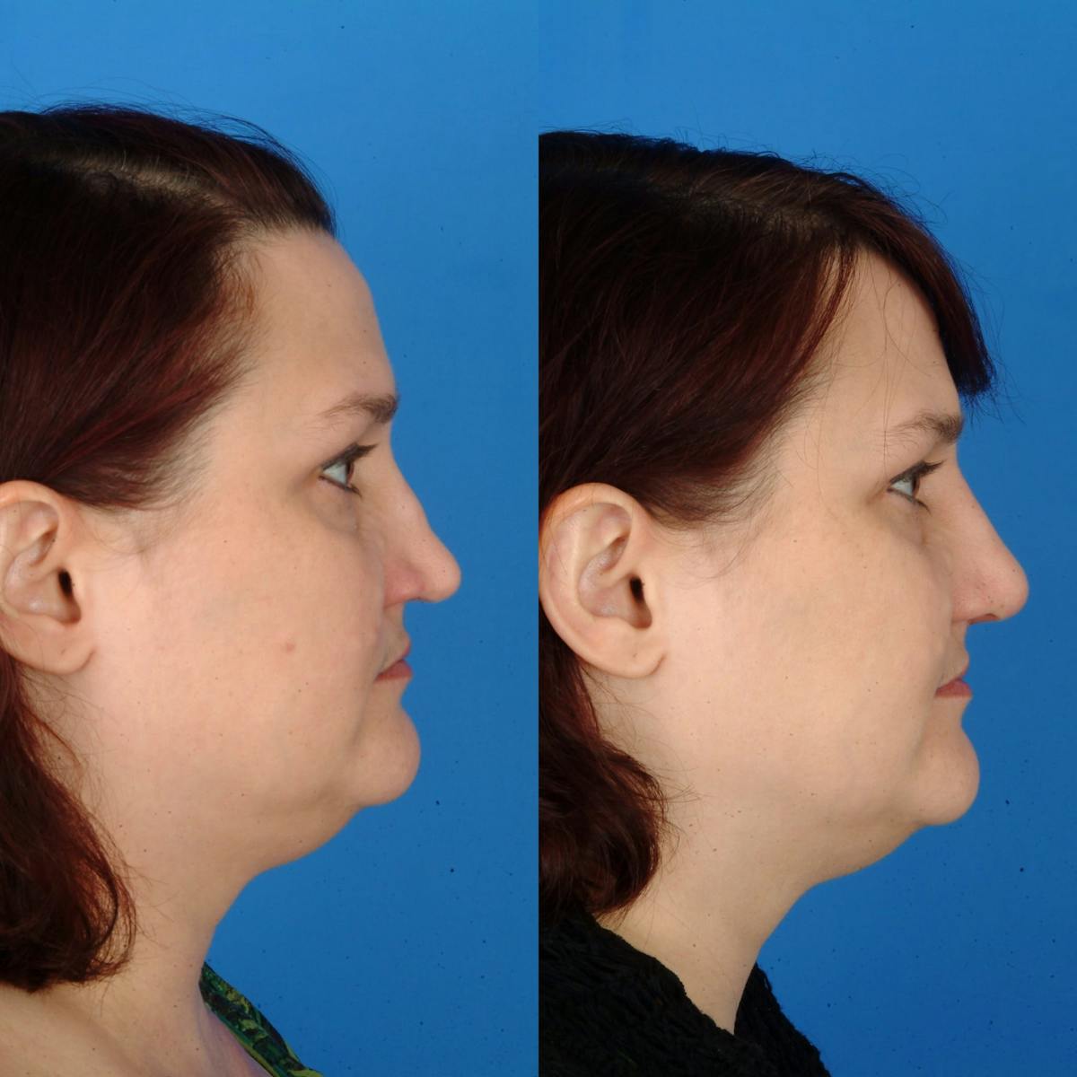 Rhinoplasty Before & After Gallery - Patient 179508149 - Image 1