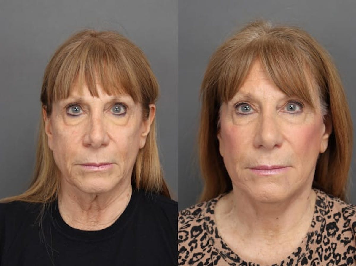 Facelifts Before & After Gallery - Patient 179508364 - Image 1