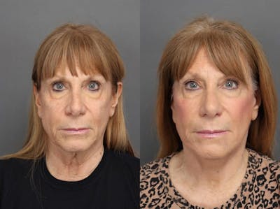 Facelifts Before & After Gallery - Patient 179508364 - Image 1