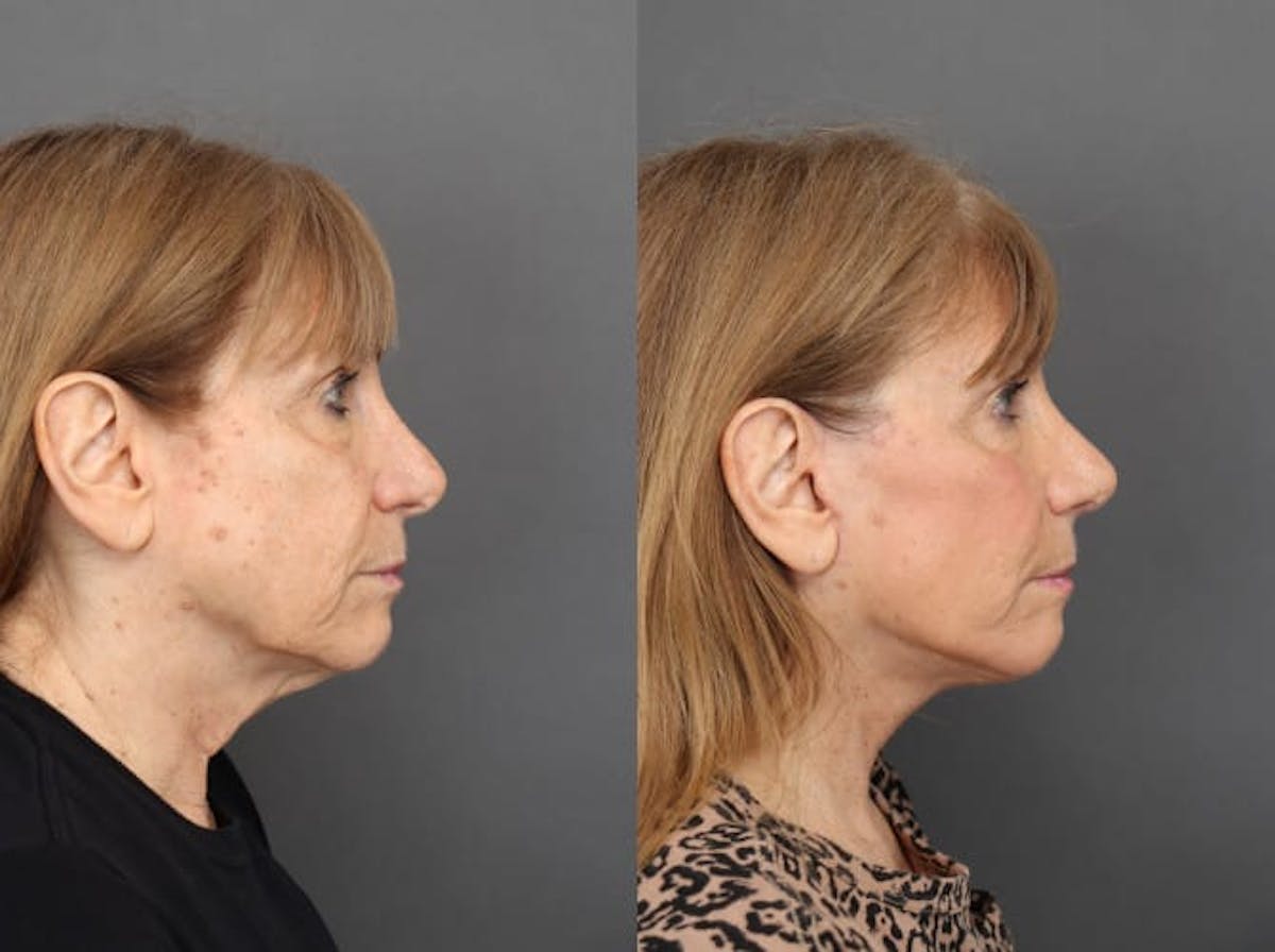 Rhinoplasty Before & After Gallery - Patient 179508362 - Image 2