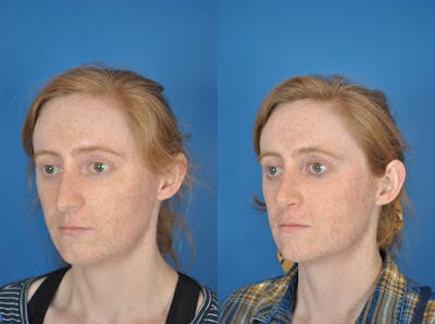 Rhinoplasty Before & After Gallery - Patient 179377270 - Image 1