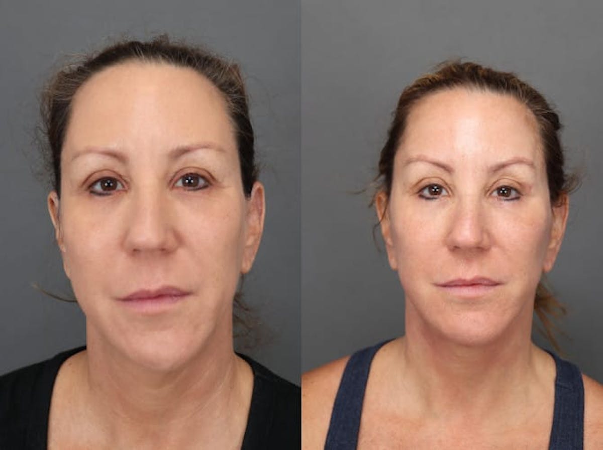 Facelifts Before & After Gallery - Patient 179508365 - Image 1