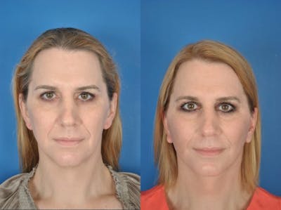 Facelifts Before & After Gallery - Patient 179508366 - Image 1