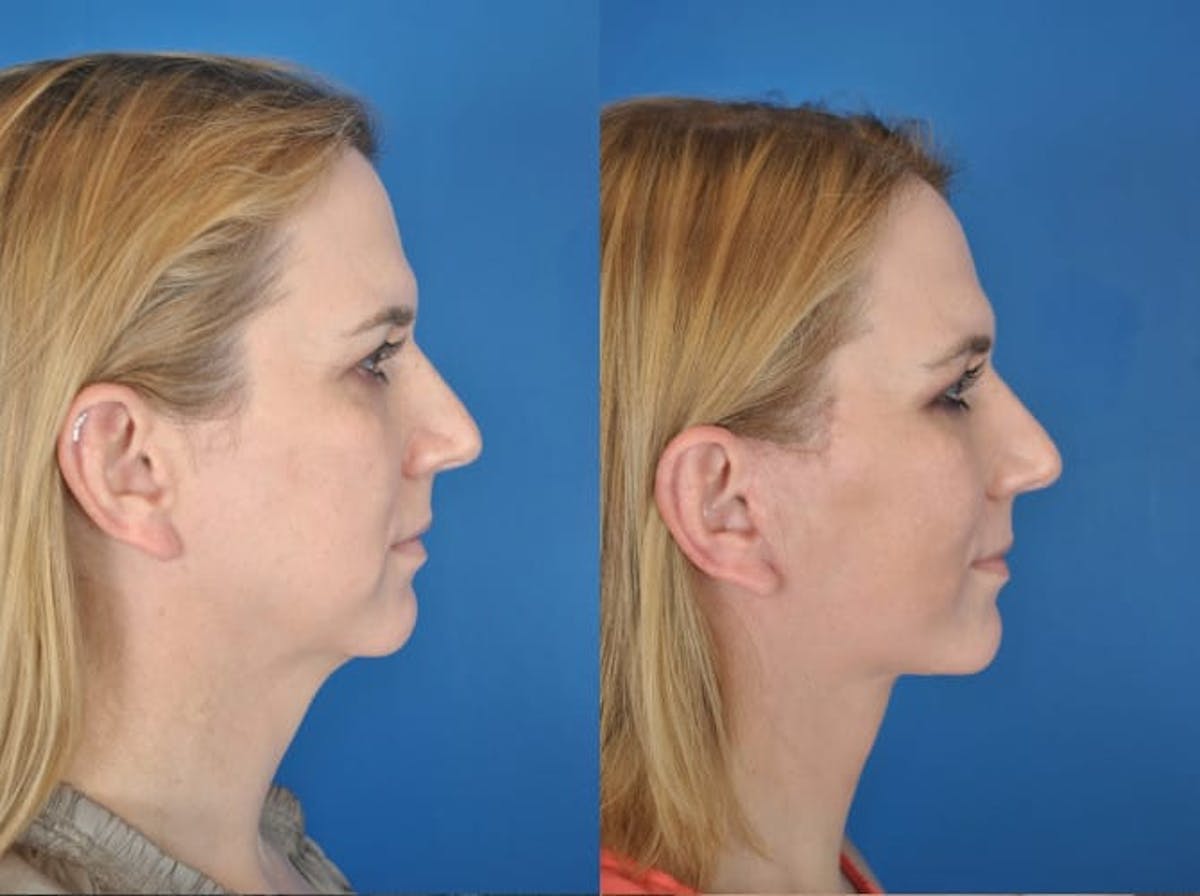 Facelifts Before & After Gallery - Patient 179508366 - Image 2
