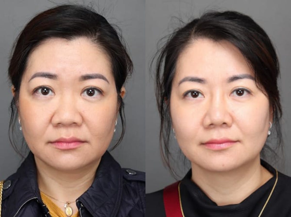 Rhinoplasty Before & After Gallery - Patient 179508489 - Image 2