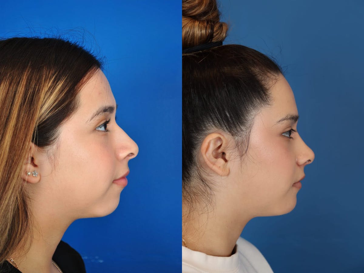 Rhinoplasty Before & After Gallery - Patient 179508932 - Image 1