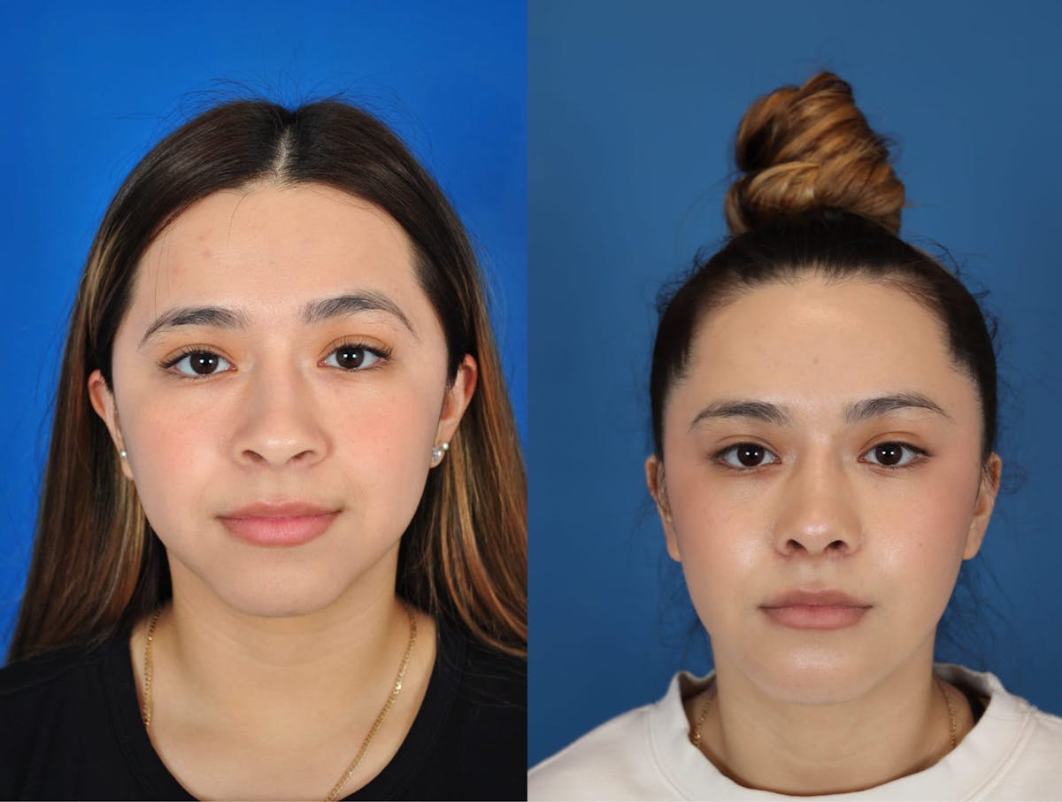 Rhinoplasty Before & After Gallery - Patient 179508932 - Image 1