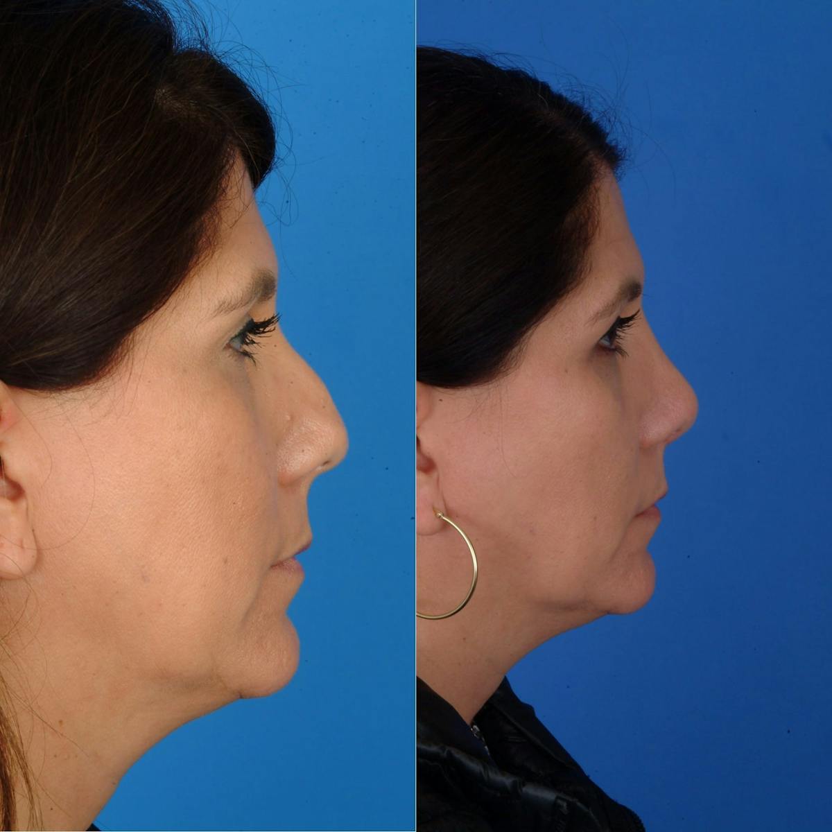 Rhinoplasty Before & After Gallery - Patient 179434069 - Image 1