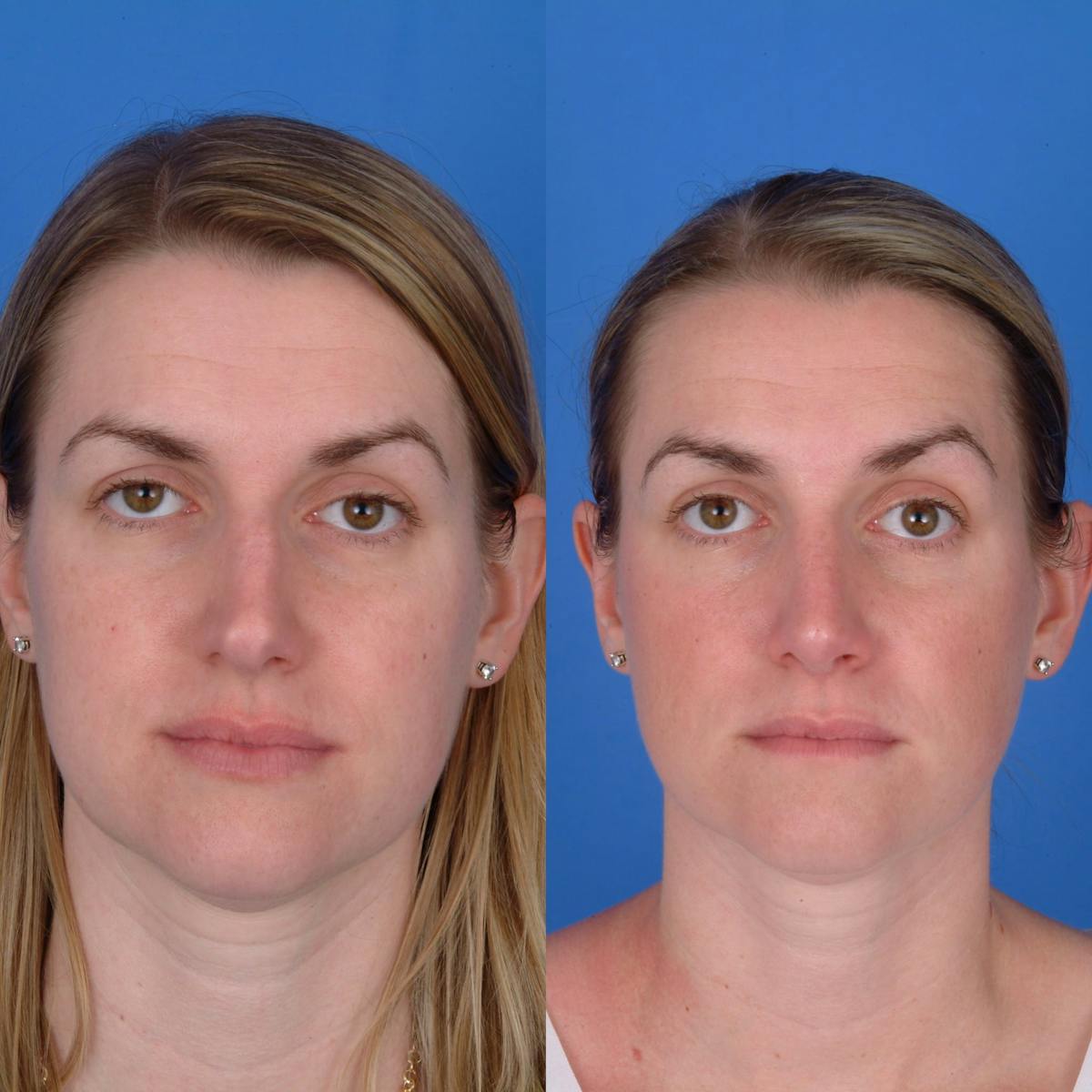Rhinoplasty Before & After Gallery - Patient 179434068 - Image 2