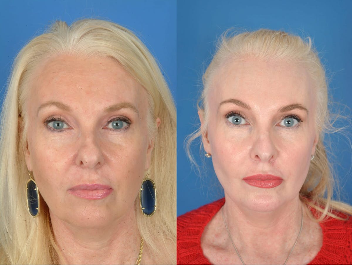 Rhinoplasty Before & After Gallery - Patient 179609463 - Image 2