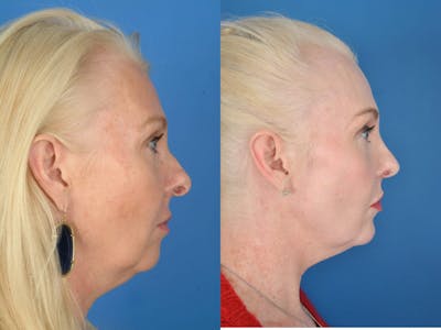 Rhinoplasty Before & After Gallery - Patient 179609463 - Image 1