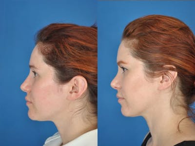 Rhinoplasty Before & After Gallery - Patient 179609468 - Image 1