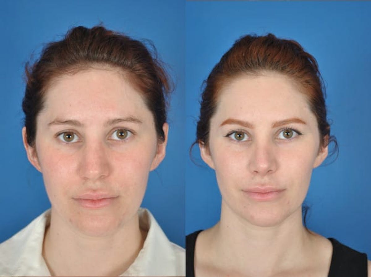 Rhinoplasty Before & After Gallery - Patient 179609468 - Image 3