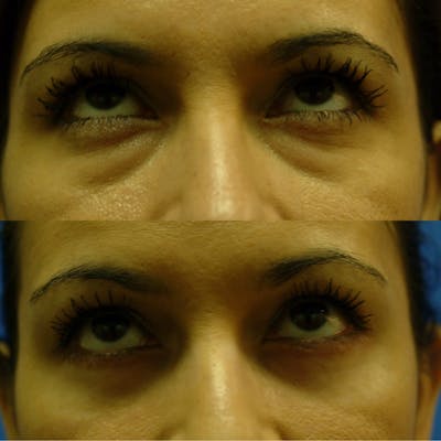 Eyelifts & Blepharoplasty Before & After Gallery - Patient 179609469 - Image 1