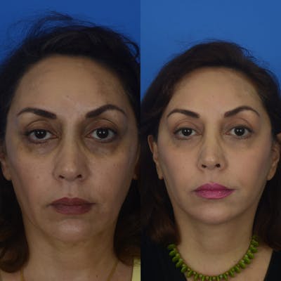 Eyelifts & Blepharoplasty Before & After Gallery - Patient 179609470 - Image 1