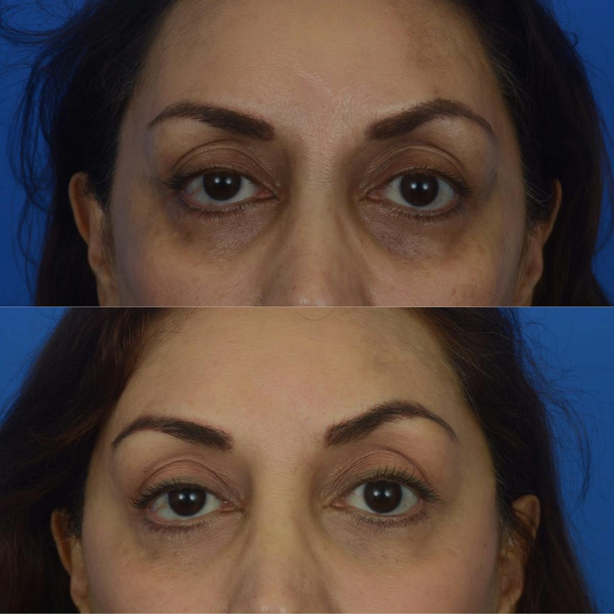 Eyelifts & Blepharoplasty Before & After Gallery - Patient 179609470 - Image 2