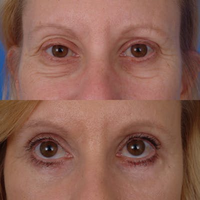 Eyelifts & Blepharoplasty Before & After Gallery - Patient 179609471 - Image 1