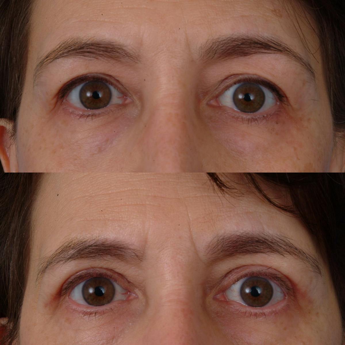 Eyelifts & Blepharoplasty Before & After Gallery - Patient 179609509 - Image 1