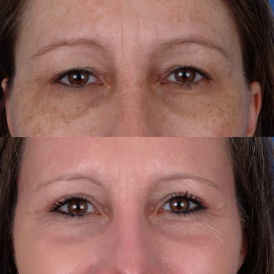 Eyelifts & Blepharoplasty Before & After Gallery - Patient 179609510 - Image 1