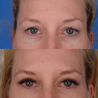 Eyelifts & Blepharoplasty Before & After Gallery - Patient 179609557 - Image 1