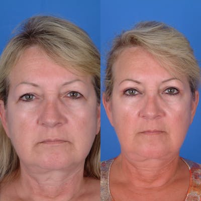 Eyelifts & Blepharoplasty Before & After Gallery - Patient 179609965 - Image 1