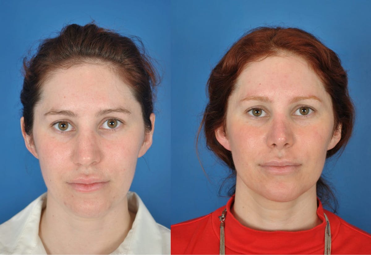 Rhinoplasty Before & After Gallery - Patient 179378918 - Image 3