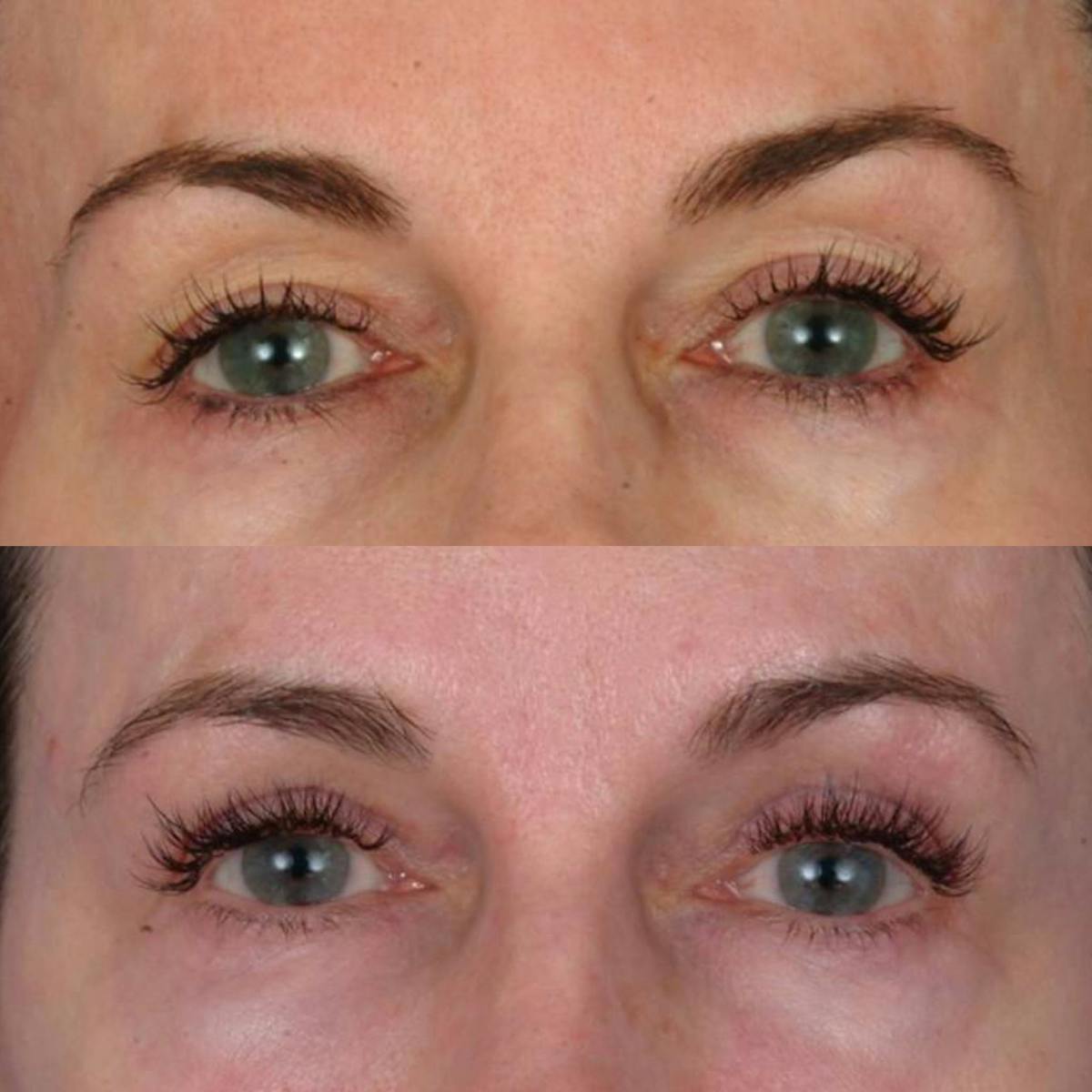 Eyelifts & Blepharoplasty Before & After Gallery - Patient 179609966 - Image 1