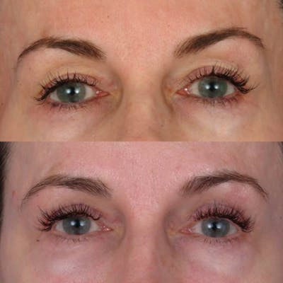 Eyelifts & Blepharoplasty Before & After Gallery - Patient 179609966 - Image 1