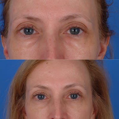 Eyelifts & Blepharoplasty Before & After Gallery - Patient 179609967 - Image 1