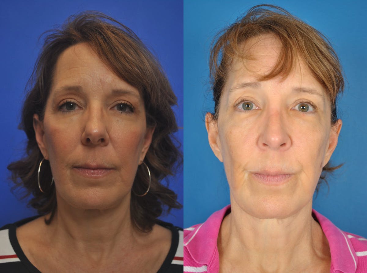 Rhinoplasty Before & After Gallery - Patient 179610132 - Image 2
