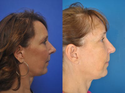 Rhinoplasty Before & After Gallery - Patient 179610132 - Image 1