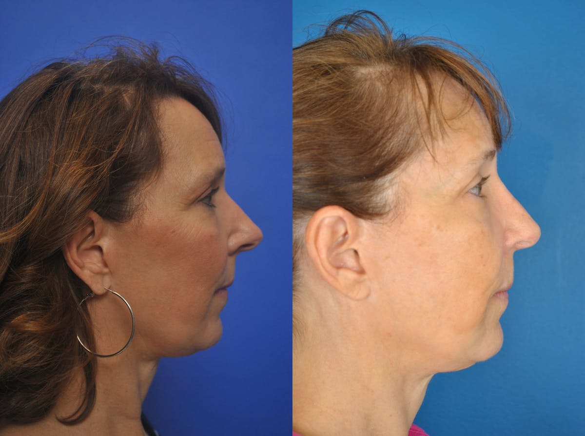 Rhinoplasty Before & After Gallery - Patient 179610132 - Image 2