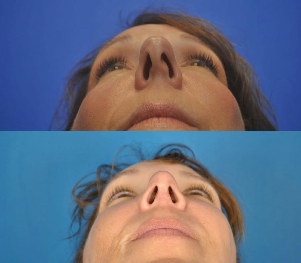Rhinoplasty Before & After Gallery - Patient 179610132 - Image 3
