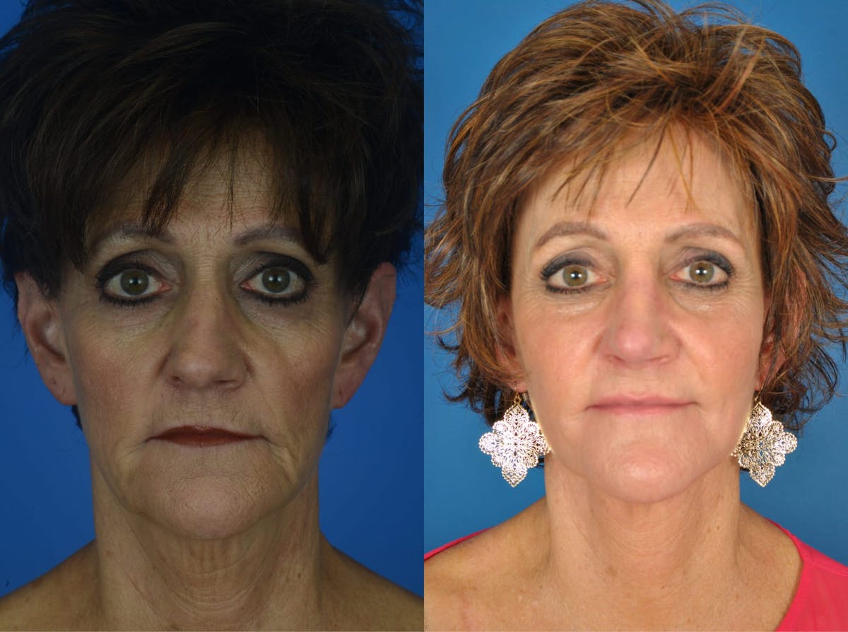 Rhinoplasty Before & After Gallery - Patient 179610700 - Image 2