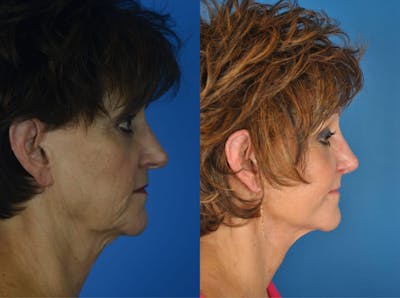 Rhinoplasty Before & After Gallery - Patient 179610700 - Image 1