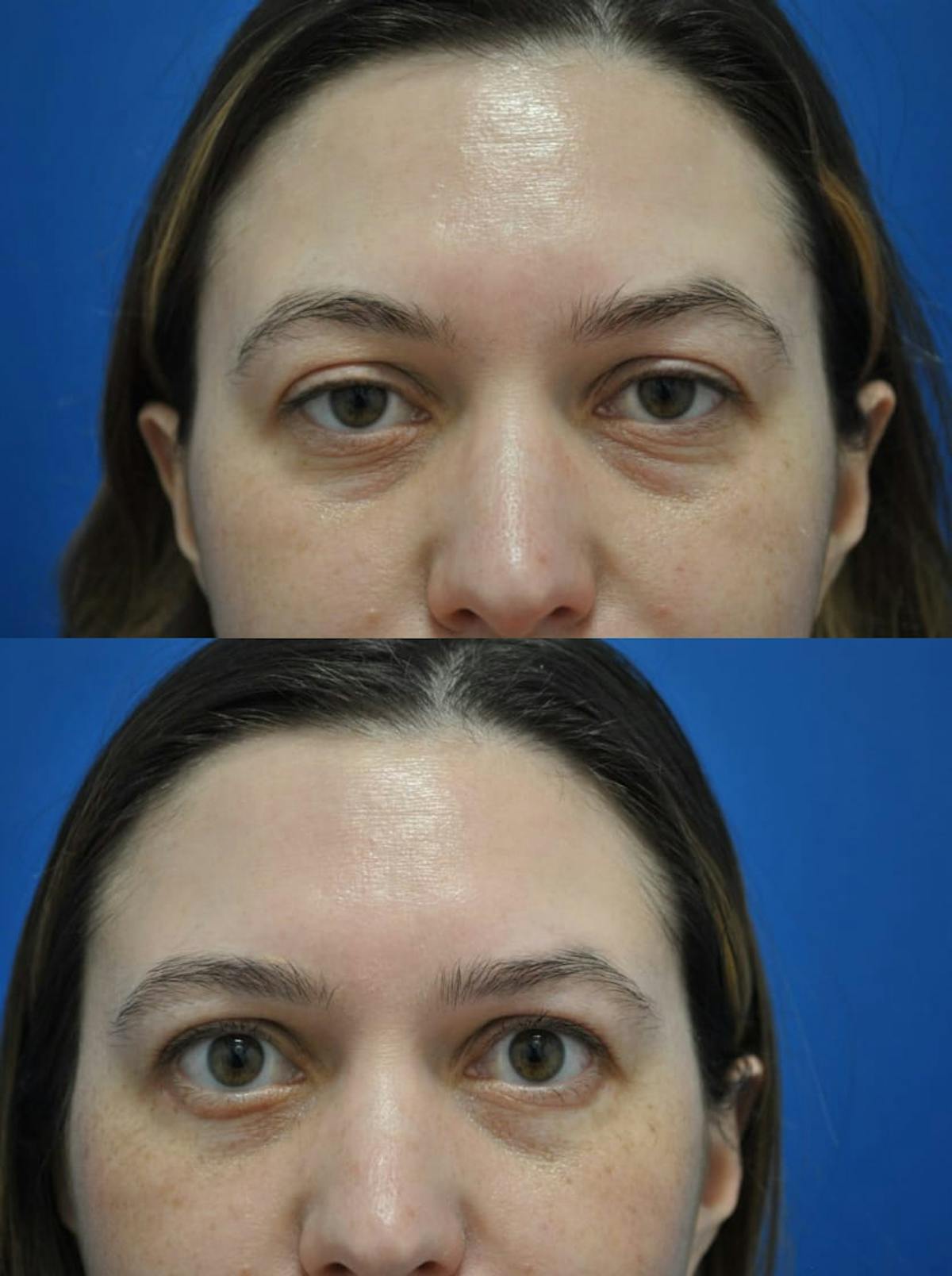Eyelifts & Blepharoplasty Before & After Gallery - Patient 179610263 - Image 1
