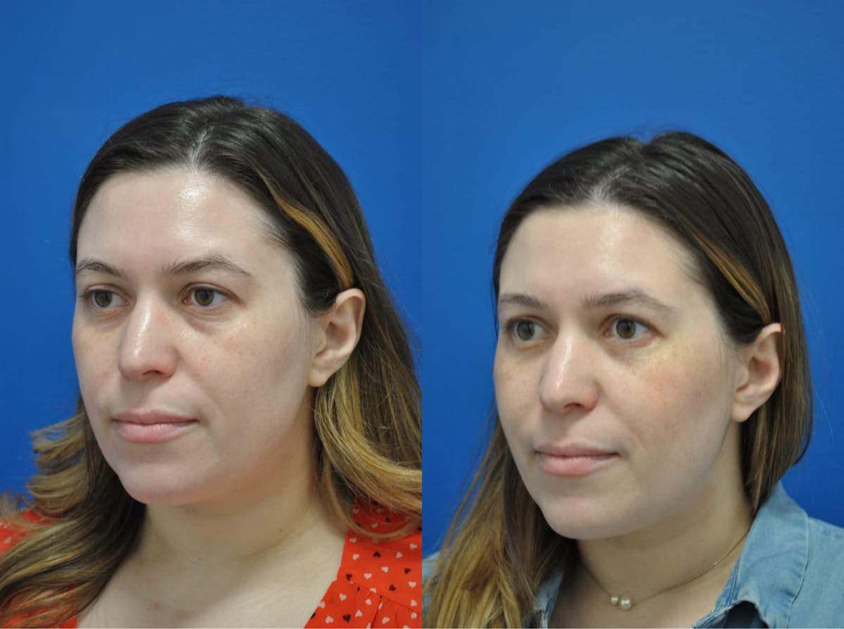 Eyelifts & Blepharoplasty Before & After Gallery - Patient 179610263 - Image 2