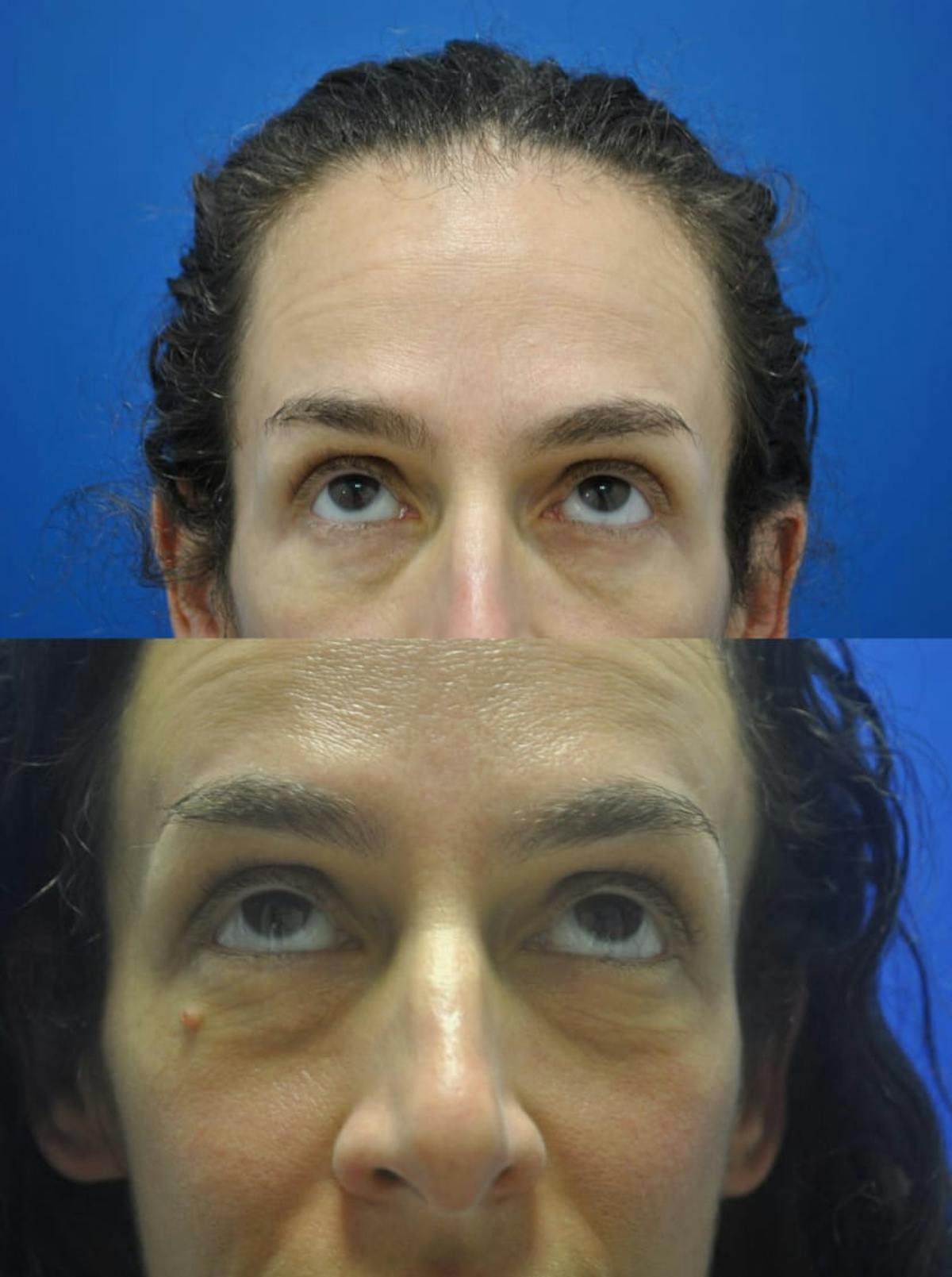 Eyelifts & Blepharoplasty Before & After Gallery - Patient 179611246 - Image 1