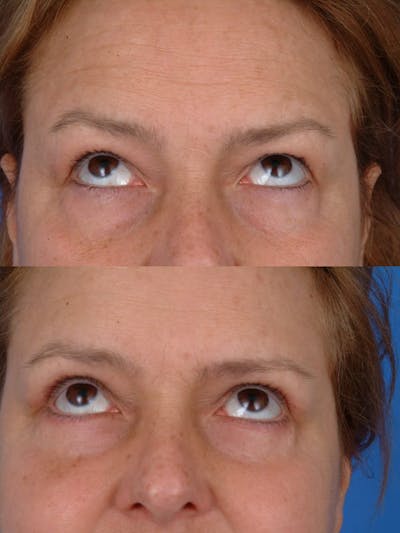 Eyelifts & Blepharoplasty Before & After Gallery - Patient 179611248 - Image 1