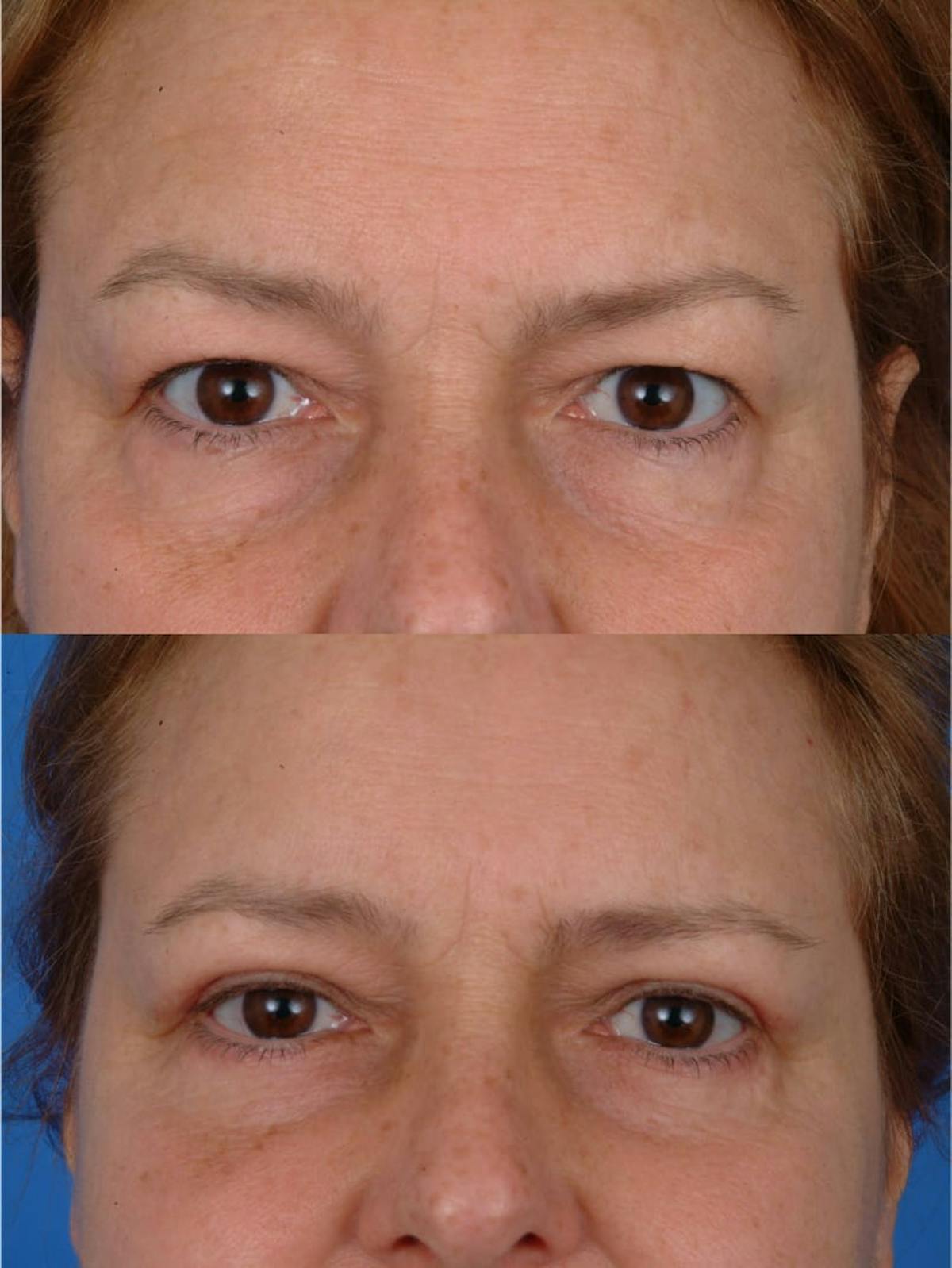 Eyelifts & Blepharoplasty Before & After Gallery - Patient 179611248 - Image 2