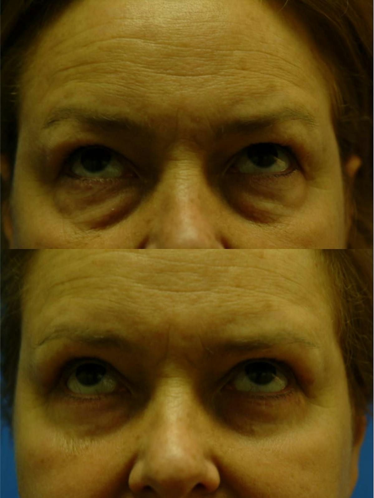 Eyelifts & Blepharoplasty Before & After Gallery - Patient 179611248 - Image 3