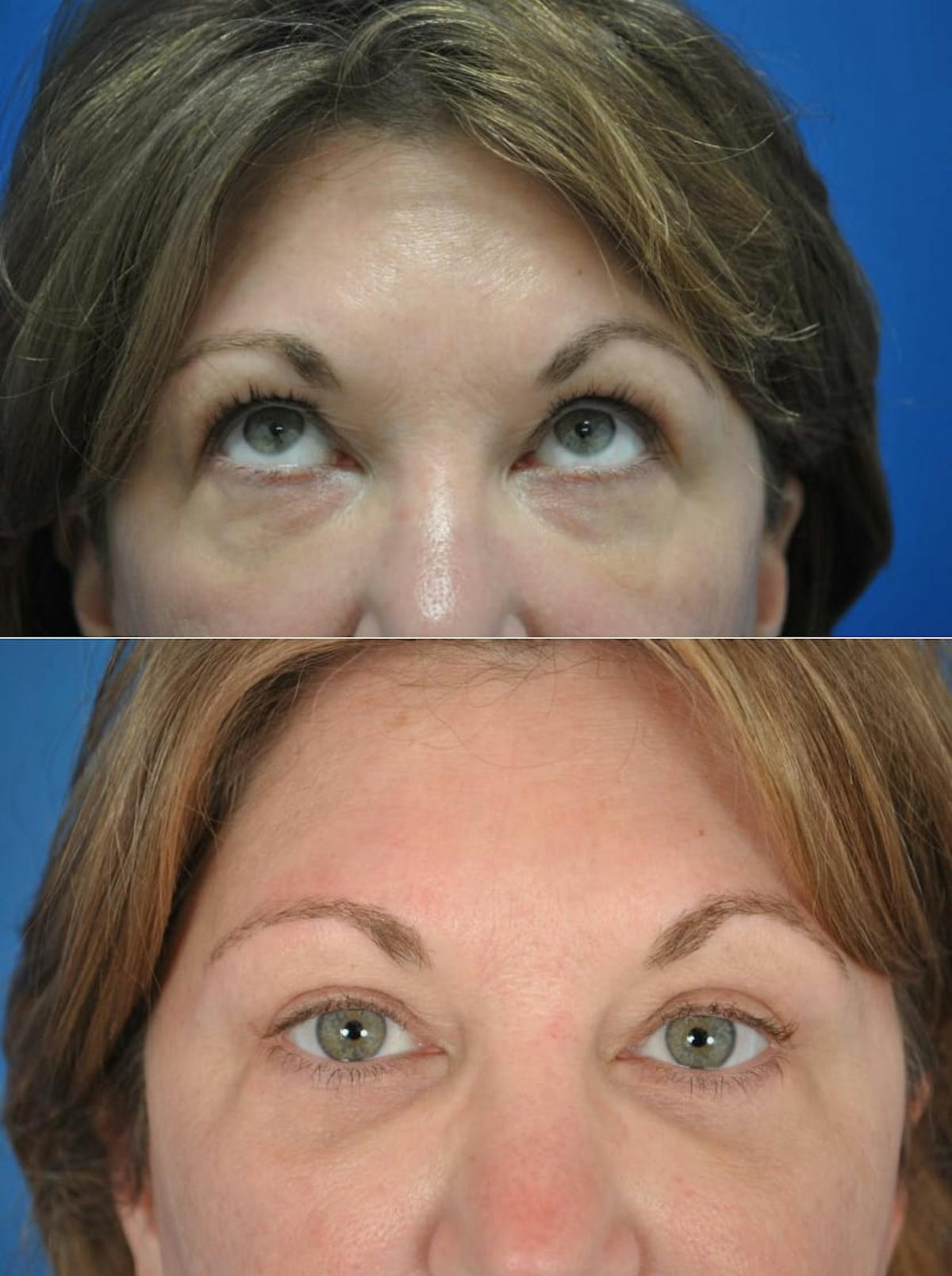 Eyelifts & Blepharoplasty Before & After Gallery - Patient 179611249 - Image 1