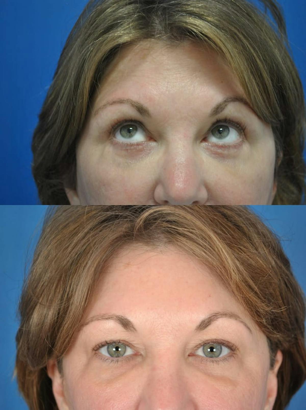Eyelifts & Blepharoplasty Before & After Gallery - Patient 179611249 - Image 2
