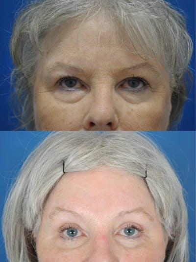 Eyelifts & Blepharoplasty Before & After Gallery - Patient 179611252 - Image 1